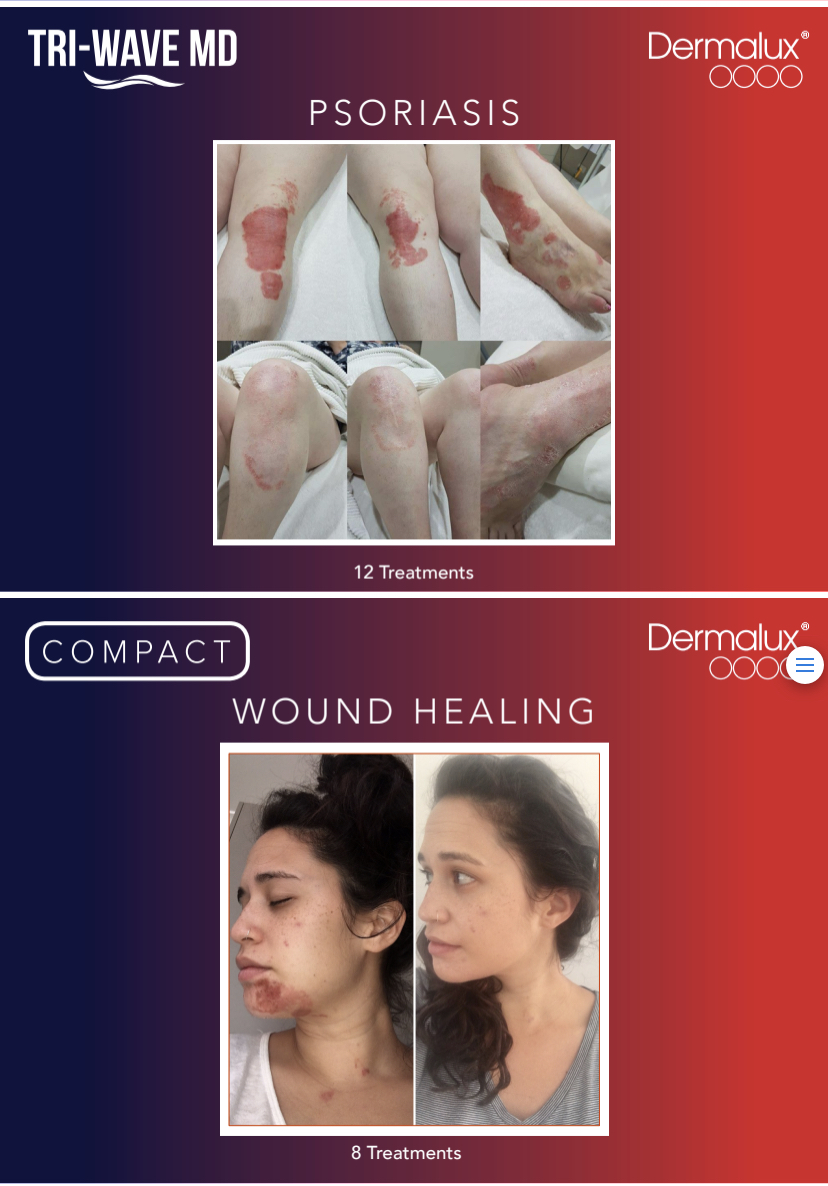Dermalux